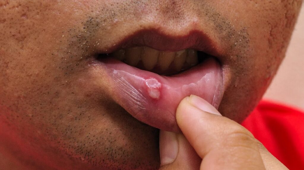 Mouth ulcers